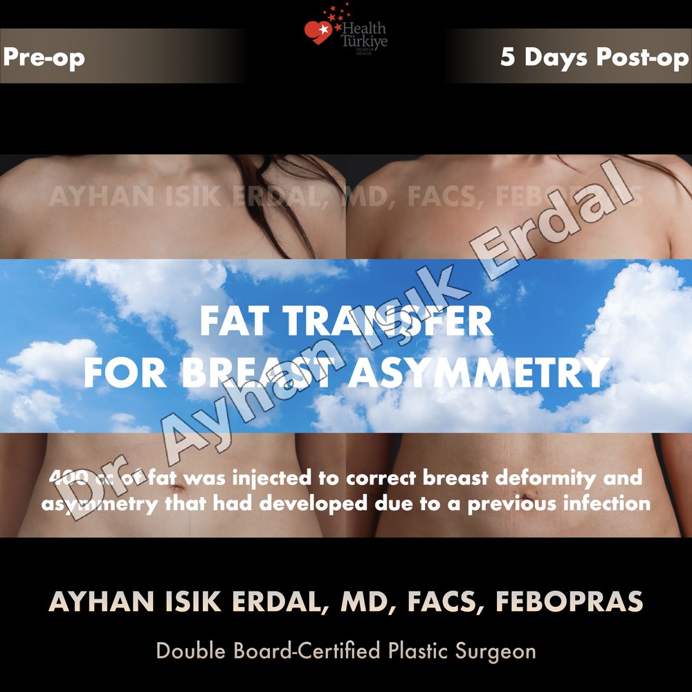 Breast fat transfer before and after — décolleté and upper pole, 5 days post-op, Dr. Ayhan Işık Erdal, Istanbul