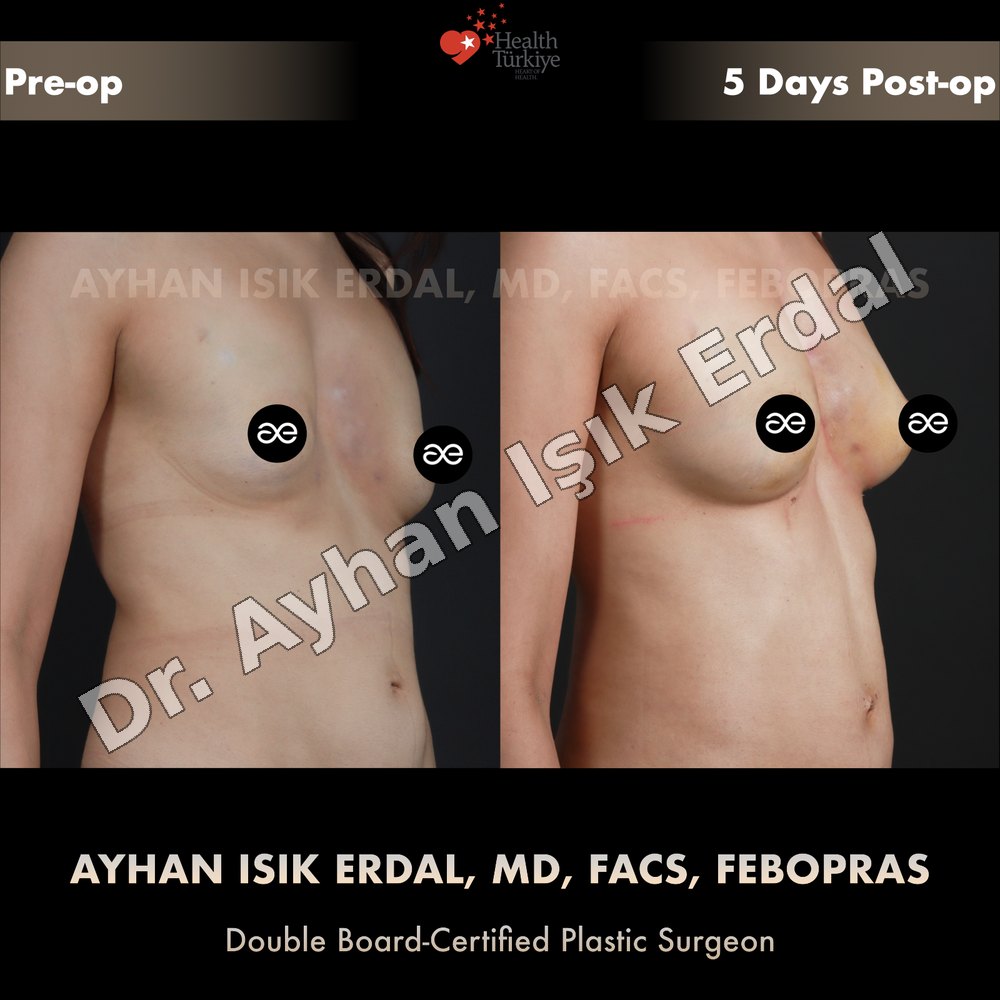 Breast fat transfer before and after — right three-quarter view, 5 days post-op, Dr. Ayhan Işık Erdal, Istanbul