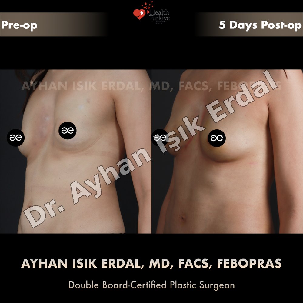 Breast fat transfer before and after — left three-quarter view, 5 days post-op, Dr. Ayhan Işık Erdal, Istanbul